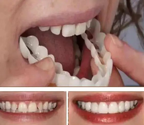 Is Swiftsmile Teeth Brace Safe? Here's a Dentist Review!