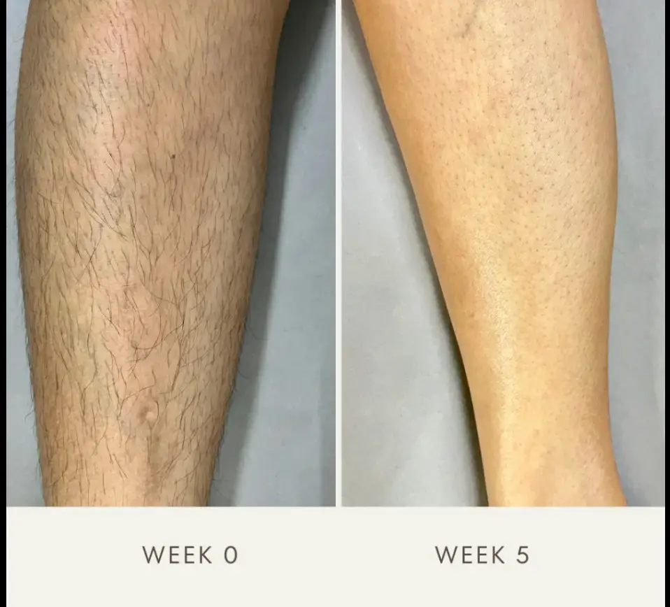 Illumi Hair Removal Reviews Here s My Reviews Before After Photos